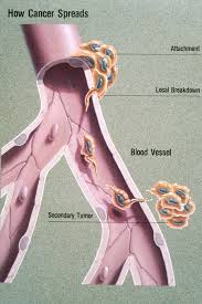 cáncer de próstata metástasis más frecuentes